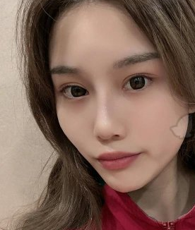 南宁悦星可靠吗?医生陈美庆玻尿酸丰面部案例