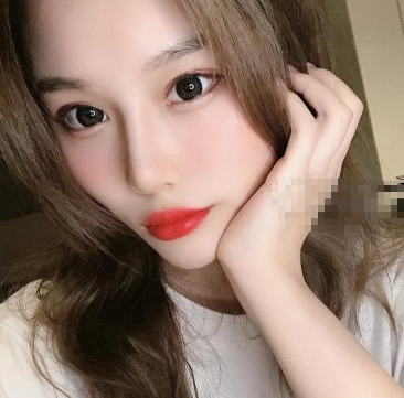 南宁悦星可靠吗?医生陈美庆玻尿酸丰面部案例