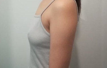 黄名斗隆胸果好吗?妹纸南京美贝尔隆胸分享