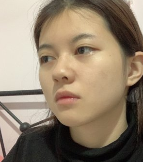 重庆光博士陈健医生自脂丰面颊果咋样?
