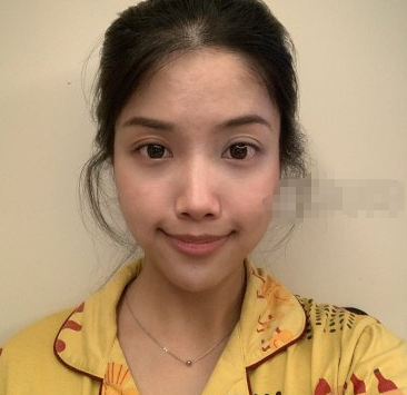 陶亮医生面部填充好不好?重庆光博士案例分享