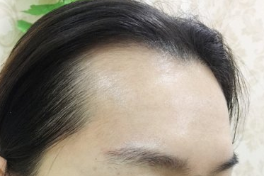 北京忆美怎样?小姐姐半长期纹发际线术后分享