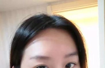 北京忆美怎样?小姐姐半长期纹发际线术后分享