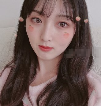 北京华悦府眼部手术如何 张鹏医生眼部手术案例分享