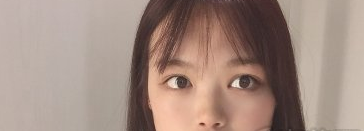 河南汇星整形靠谱不?吴勇切开双眼皮案例分享