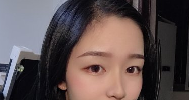 北京妹子华悦府医美眼部手术案例分享附带果图