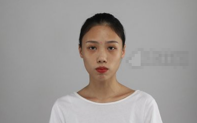 重庆华美面部填充可靠不?陈凯医生面填案例