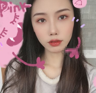 重庆华美面部填充可靠不?陈凯医生面填案例