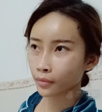 深圳军科整形好不?刘月更填充面部案例展示