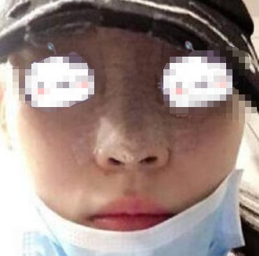 广东深圳美莱医美隆鼻术后一月半果分享