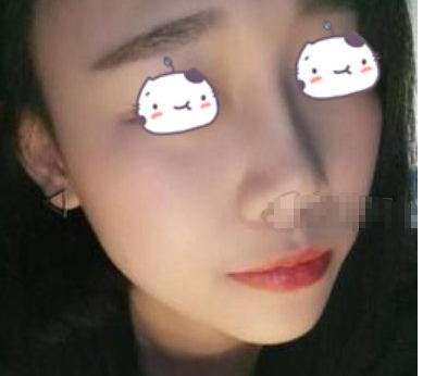 广东深圳美莱医美隆鼻术后一月半果分享