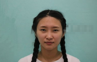 浙江杭州天鑫医疗整形李晓东医生隆鼻好不好?