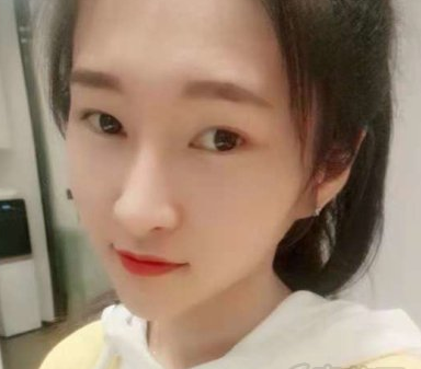 浙江杭州天鑫医疗整形李晓东医生隆鼻好不好?