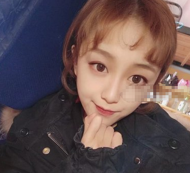 长沙美研医疗美容医生高敏下巴吸脂案例分享