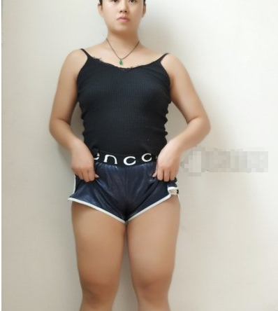 重庆鹏爱医美可靠不? 邹礼西撒腿吸脂案例分享