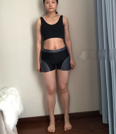 鹏爱医疗美容怎样?重庆小姐姐吸脂术后分享
