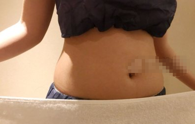 杭州薇琳医疗美容医生陶斯静冷冻溶脂怎么样?