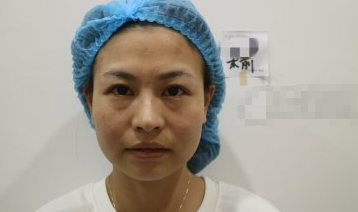 浙江杭州东方整形美容超激光美肤术后感受及果