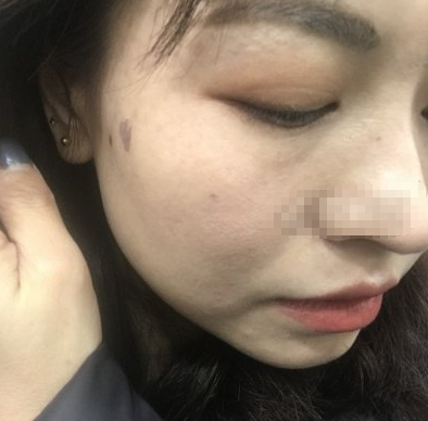 浙江杭州东方整形美容超激光美肤术后感受及果