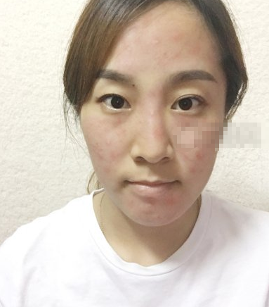 合肥华美医院红蓝光祛痘怎么样?案例实测