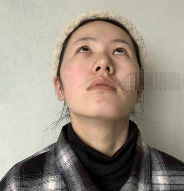 深圳艺星好不?牛克辉医生脂肪填充面部案例