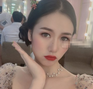 深圳艺星好不?牛克辉医生脂肪填充面部案例