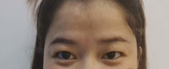 上海仁爱医院个双眼皮可靠吗?孙宇医生案例