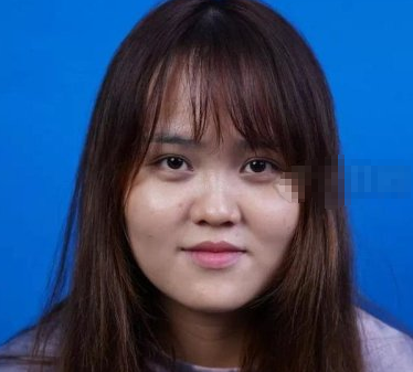 深圳福华医疗美容顾伟明隆鼻果如何?