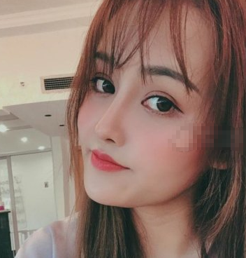 深圳福华医疗美容顾伟明隆鼻果如何?