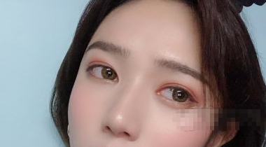 王志东做双眼皮好吗?深圳福华眼部手术案例分享