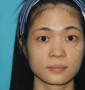 李子鹏隆鼻可靠吗?深圳鹏程医疗美容案例分享