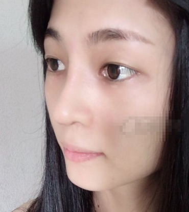 李子鹏隆鼻可靠吗?深圳鹏程医疗美容案例分享