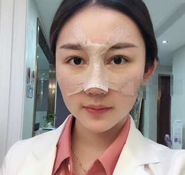 深圳妍熙医疗美容医生陈桂飞鼻部手术案例分享