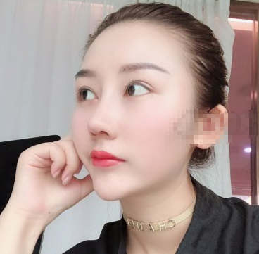 深圳妍熙医疗美容医生陈桂飞鼻部手术案例分享