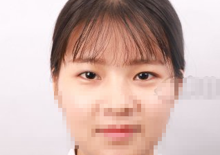 深圳妍熙医美周敏医生眼部手术术后三月分享