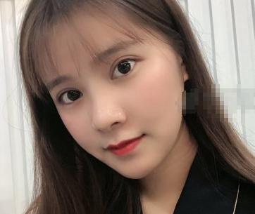 深圳妍熙医美周敏医生眼部手术术后三月分享