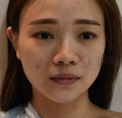 深圳美莱医疗美容医生梁晓健鼻部手术案例分享