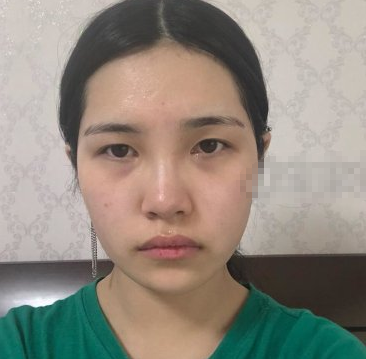 上海愉悦美联臣V-LINE瓜子脸手术术后两月果