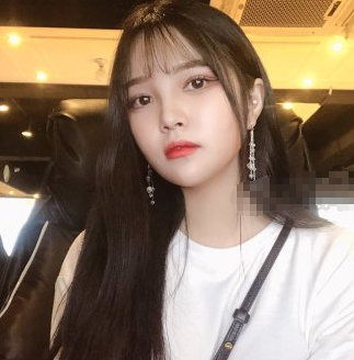 上海愉悦美联臣V-LINE瓜子脸手术术后两月果