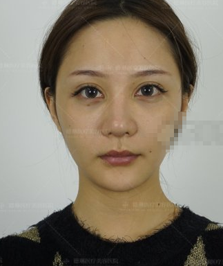 上海德琳医疗美容医生朱麟埋线提升提升果如何？