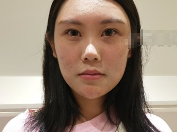 上海薇琳医疗美容医院面部吸脂一月果分享