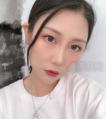 上海薇琳医疗美容医院面部吸脂一月果分享