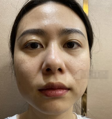 上海洁铭医疗美容刘志欣吸脂后50天术后果分享