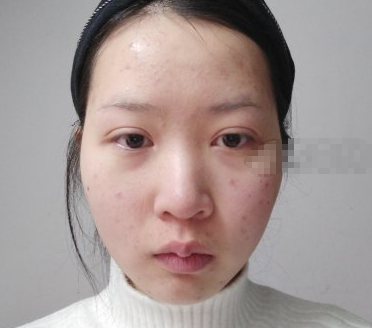 上海百达丽医疗美容医生倪锋鼻部手术案例分享