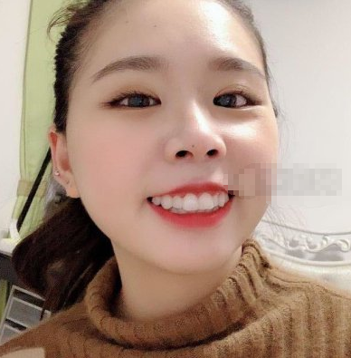 深圳福华口腔隐形矫正案例术后四月果分享