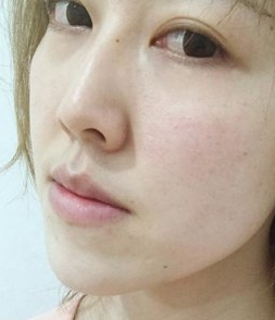 激光祛红血丝果怎样？北京欧华医疗美案例