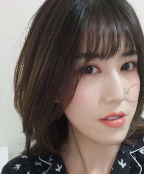 激光祛红血丝果怎样？北京欧华医疗美案例