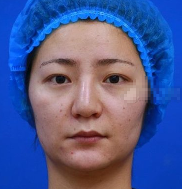 武汉乐美医美汪文娟医生埋线提升提升案例分享