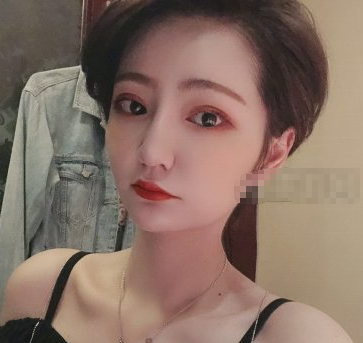武汉乐美医美汪文娟医生埋线提升提升案例分享