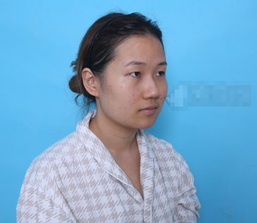 在北京圣嘉荣切了双眼皮之后,真的很后悔